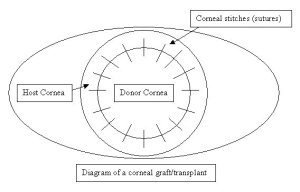 corneal graft diagram