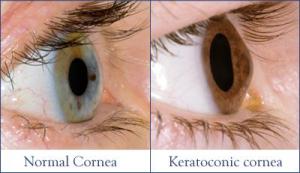 Keratoconus%20C3-R