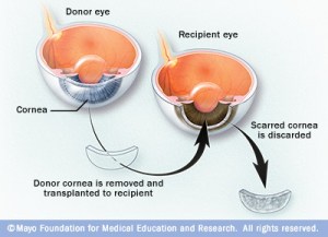 vi7_cornea_transplant