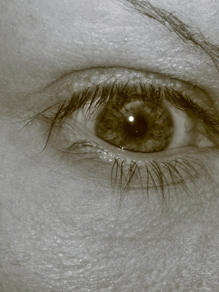 14 months post-graft