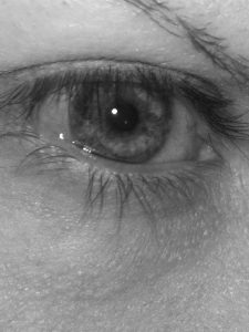 15 months post graft no stitches