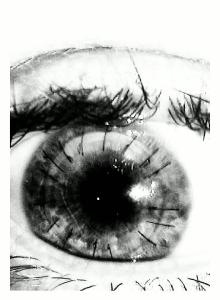 3 months post graft 3 stitches out