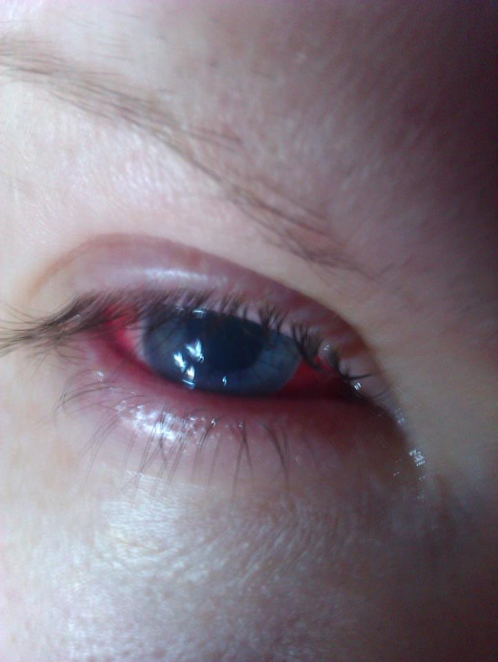 my eye day 1 post graft