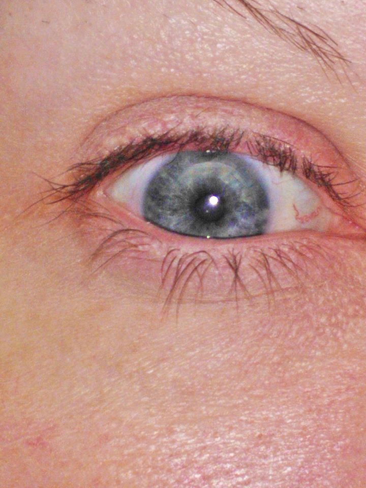 no stitches 15 months post graft